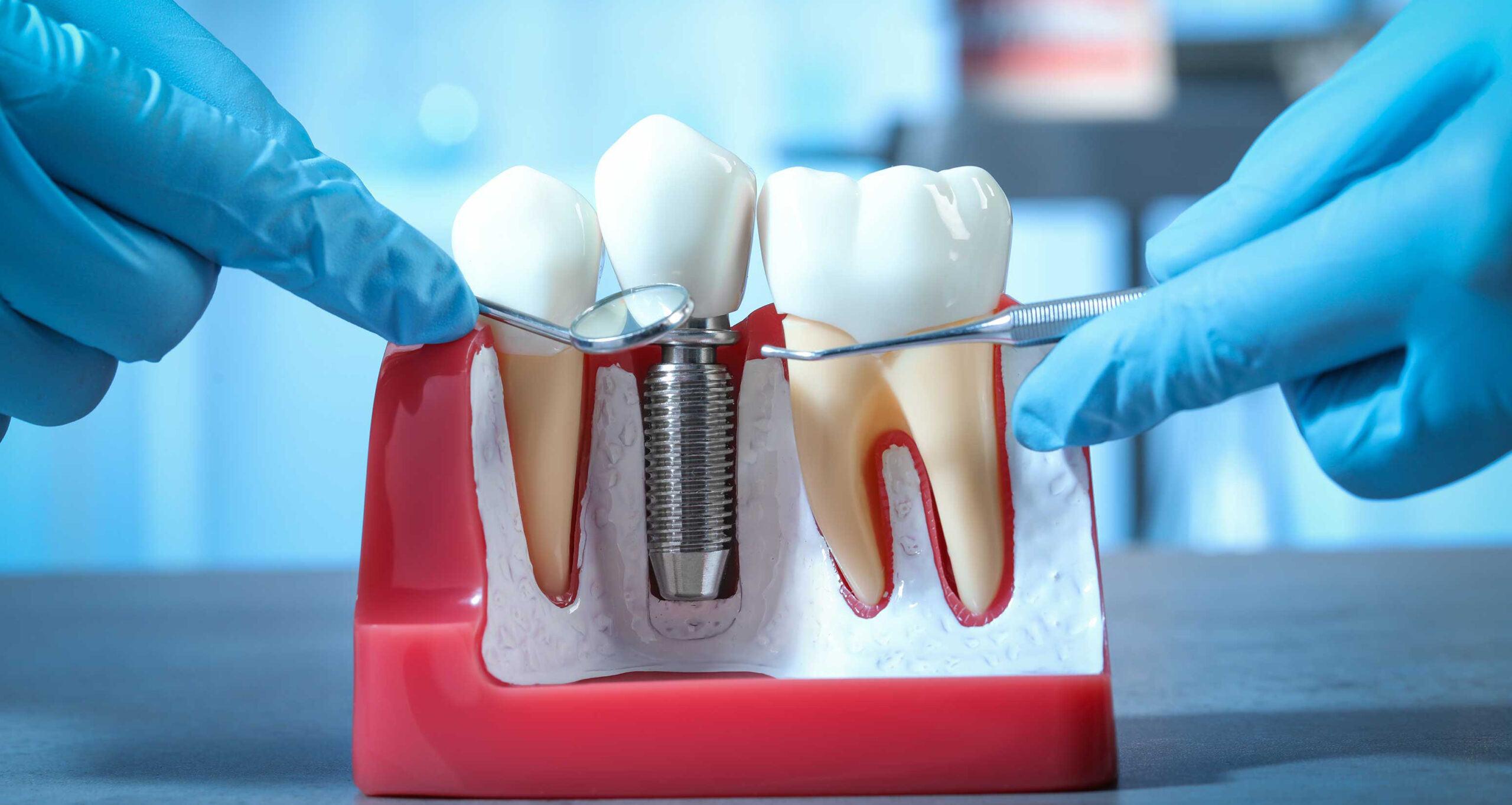 علت پس زدن ایمپلنت دندان 1 علت پس زدن ایمپلنت دندان