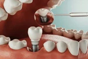 مراقبت و اقدامات بعد از کاشت ایمپلنت دندان