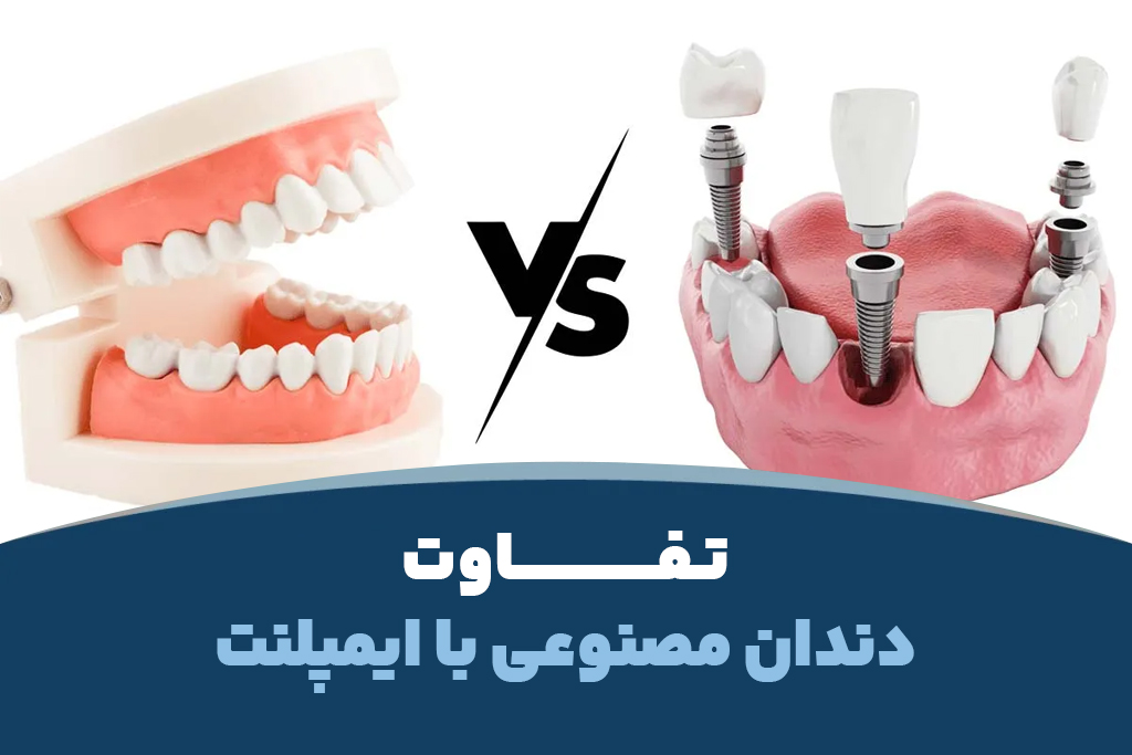 تفاوت دست دندان (دندان مصنوعی) با ایمپلنت