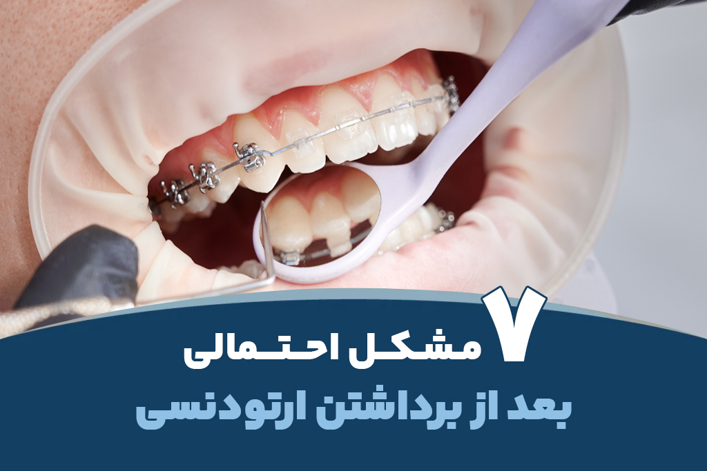 7 مشکل احتمالی بعد از برداشتن ارتودنسی