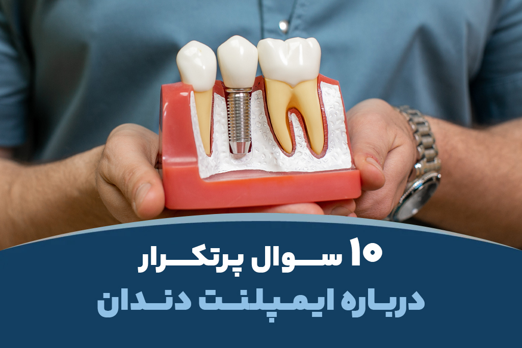 ۱۰ سوال پرتکرار درباره ایمپلنت دندان