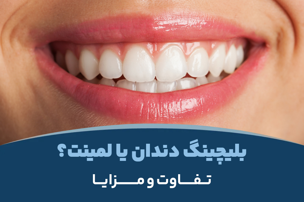 بلیچینگ دندان یا لمینت؟ تفاوت و مزایا