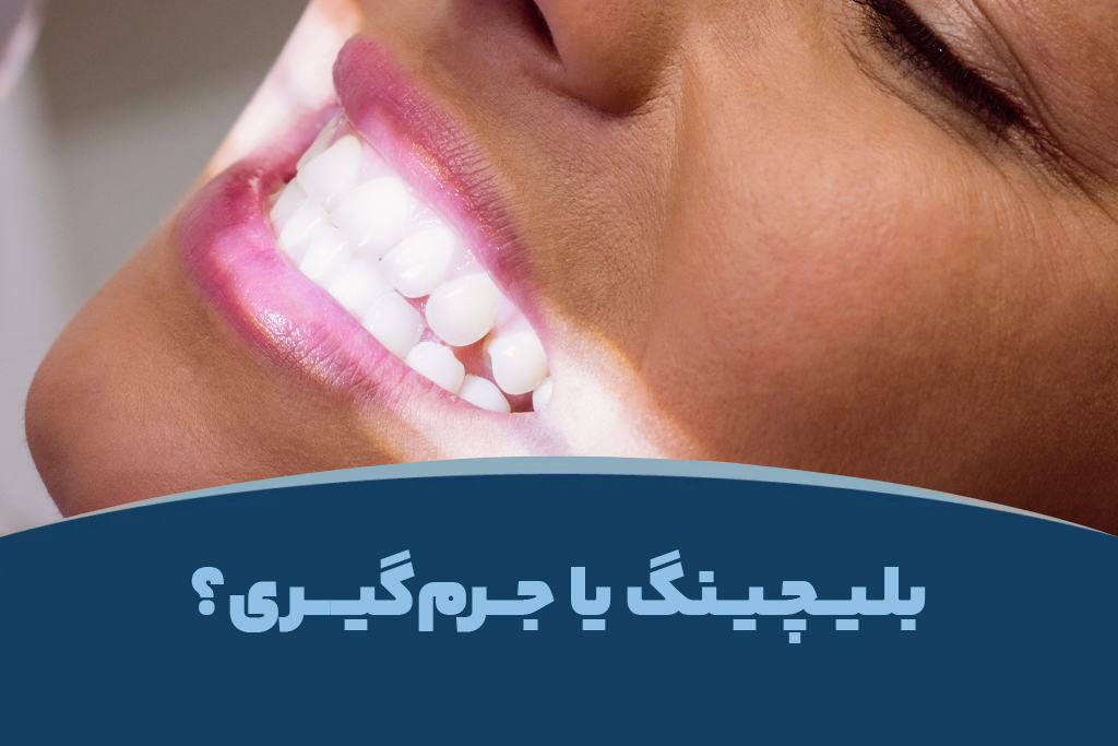 بهترین روش سفید کردن دندان‌ها: بلیچینگ یا جرم‌گیری؟