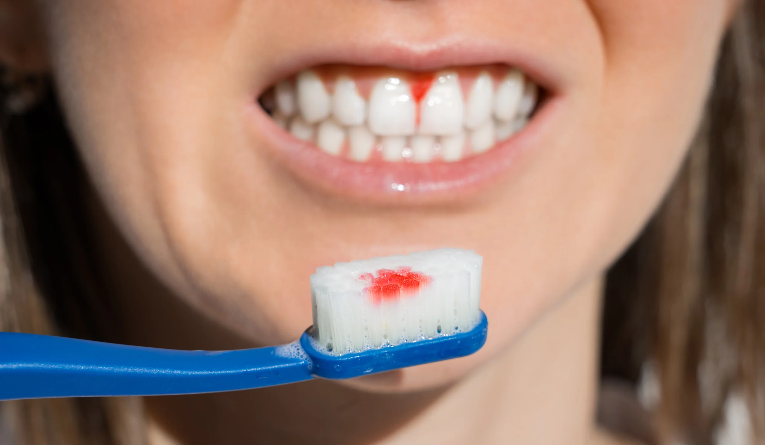 ۶ روش برای درمان خونریزی لثه هنگام مسواک زدن 1 ۶ روش برای درمان خونریزی لثه هنگام مسواک زدن