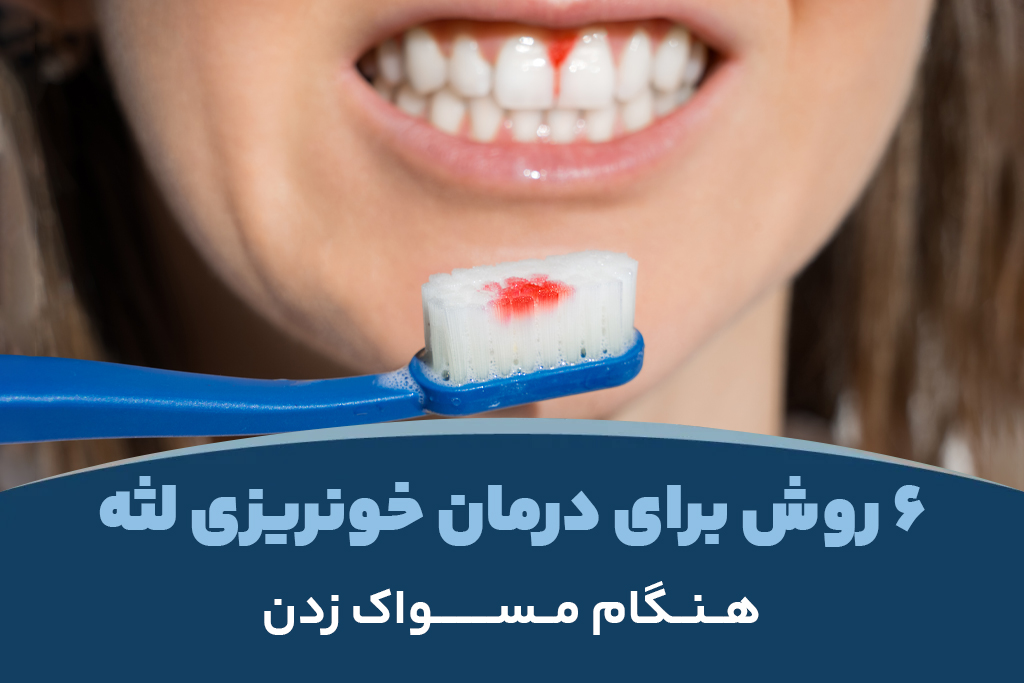 ۶ روش برای درمان خونریزی لثه هنگام مسواک زدن