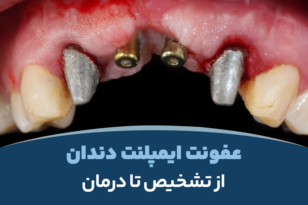 عفونت ایمپلنت دندان؛ از تشخیص تا درمان