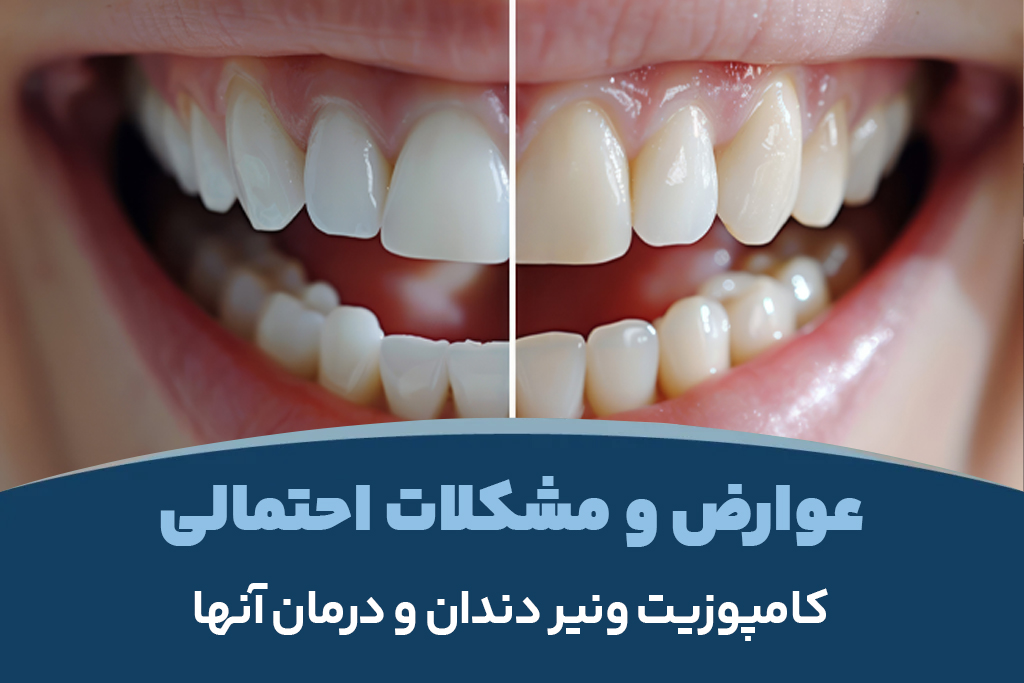 عوارض و مشکلات احتمالی کامپوزیت ونیر دندان و درمان آنها