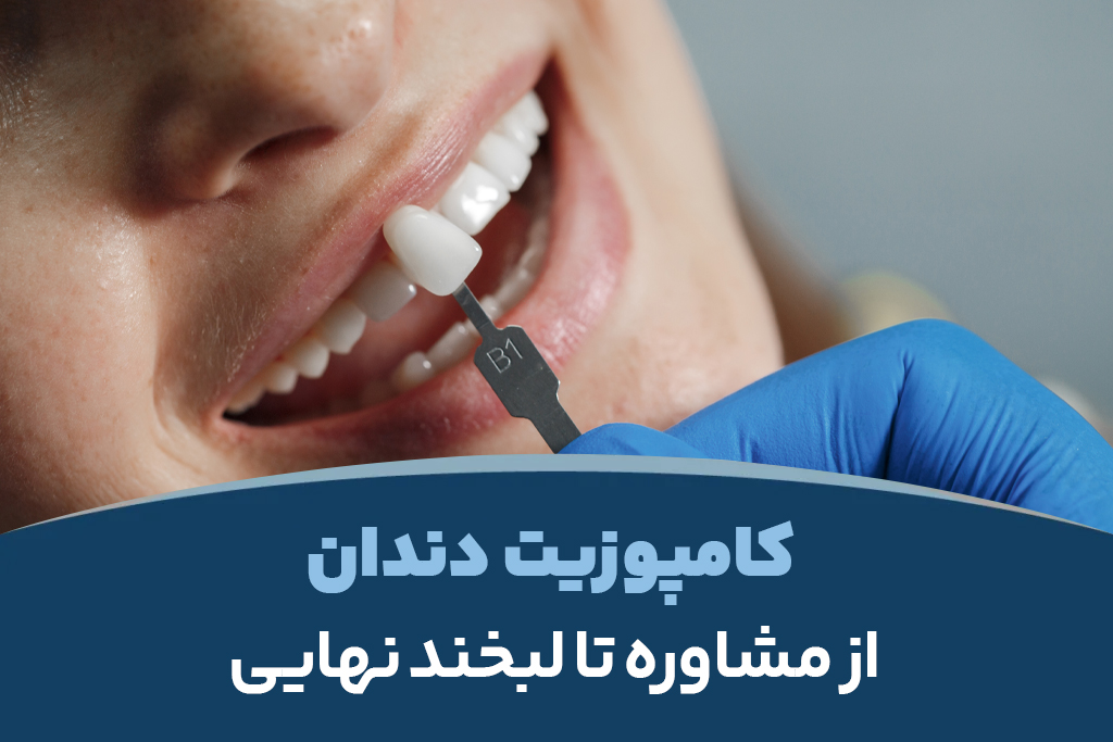 مراحل انجام کامپوزیت دندان از مشاوره تا لبخند نهایی