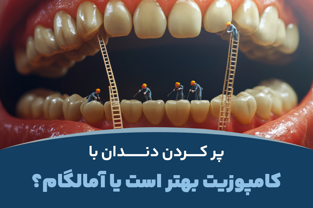 پر کردن دندان با کامپوزیت بهتر است یا آمالگام؟