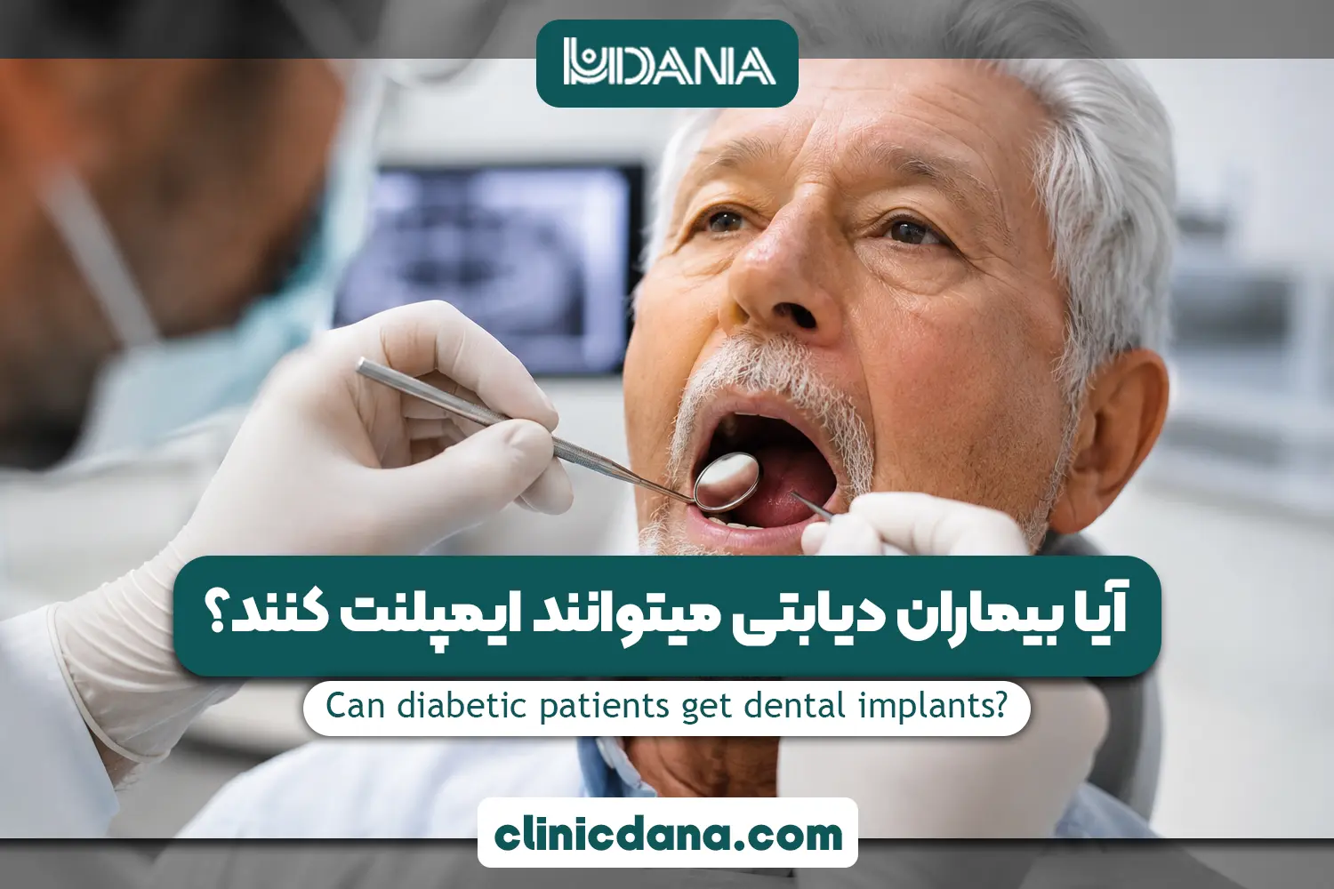 آیا بیماران دیابتی میتوانند ایمپلنت کنند؟ بررسی شرایط، HbA1c و خطرات