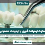 تفاوت ایمپلنت فوری با ایمپلنت معمولی چیست؟