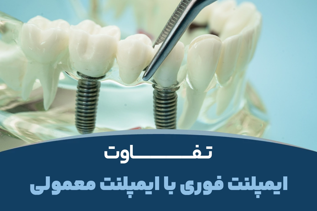 تفاوت ایمپلنت فوری با ایمپلنت معمولی چیست؟