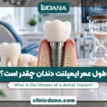 طول عمر ایمپلنت دندان چقدر است؟ ماندگاری ایمپلنت در سال 2026