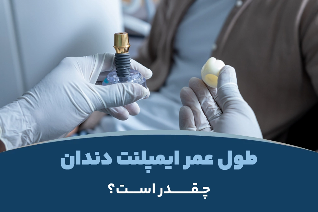 طول عمر ایمپلنت دندان چقدر است؟