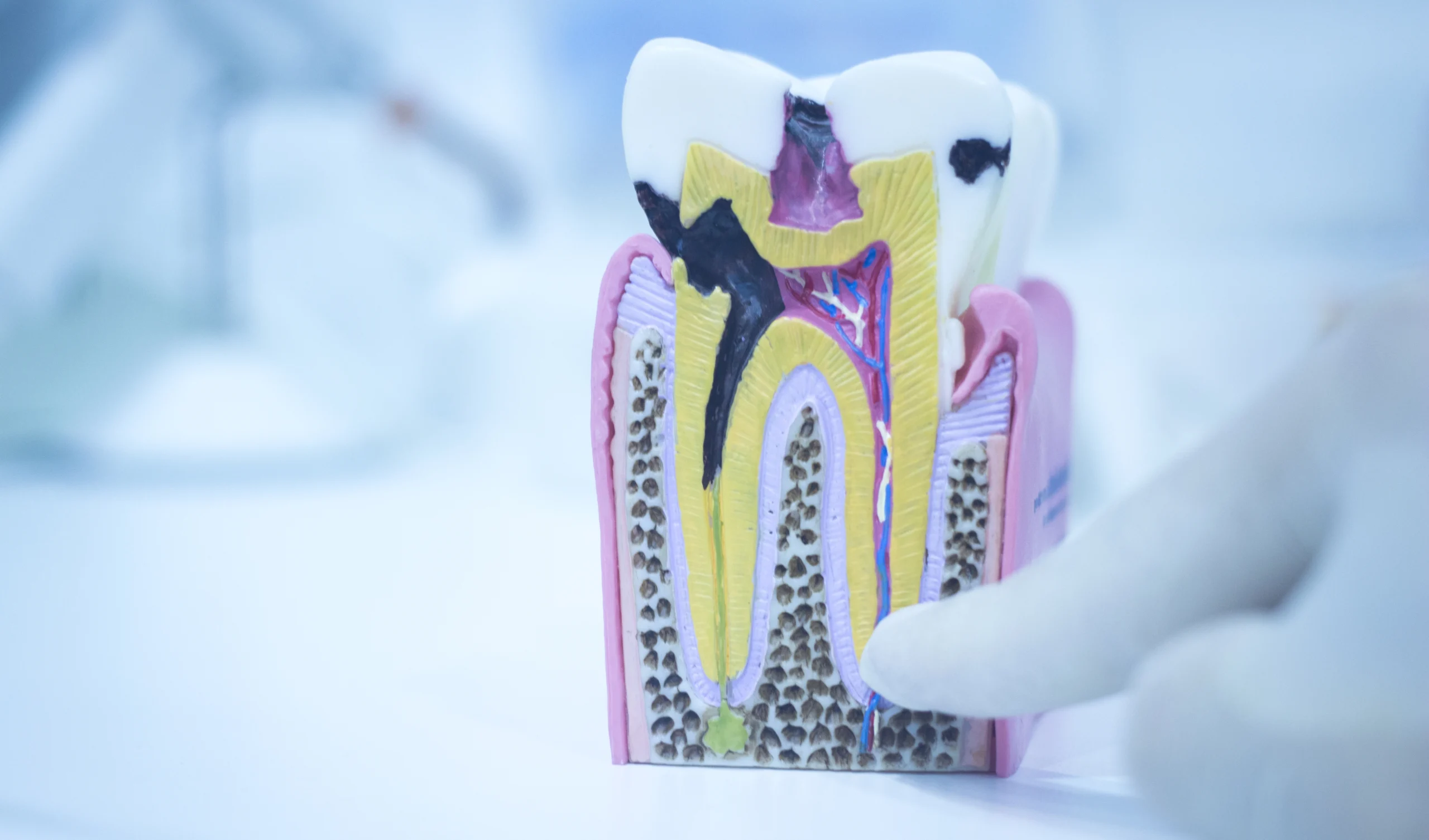 9 دلیل درد دندان عصب کشی شده