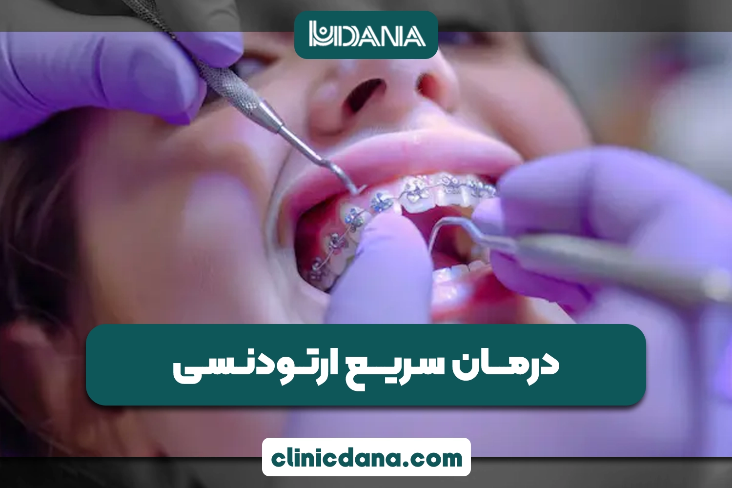 ارتودنسی سریع؛ آیا می توان مدت درمان ارتودنسی را کاهش داد؟