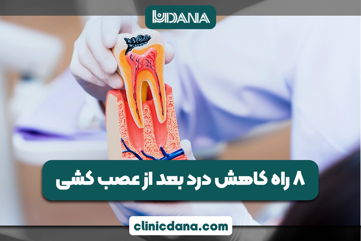 آیا درد بعد از عصب کشی طبیعی است؟؛ 8 راه کاهش درد بعد از عصب کشی دندان