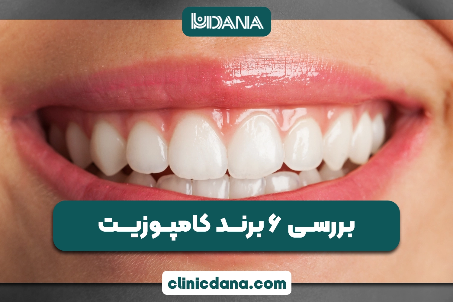 بررسی 6 برند کامپوزیت؛ کدام برند کامپوزیت ونیر بهتر است؟