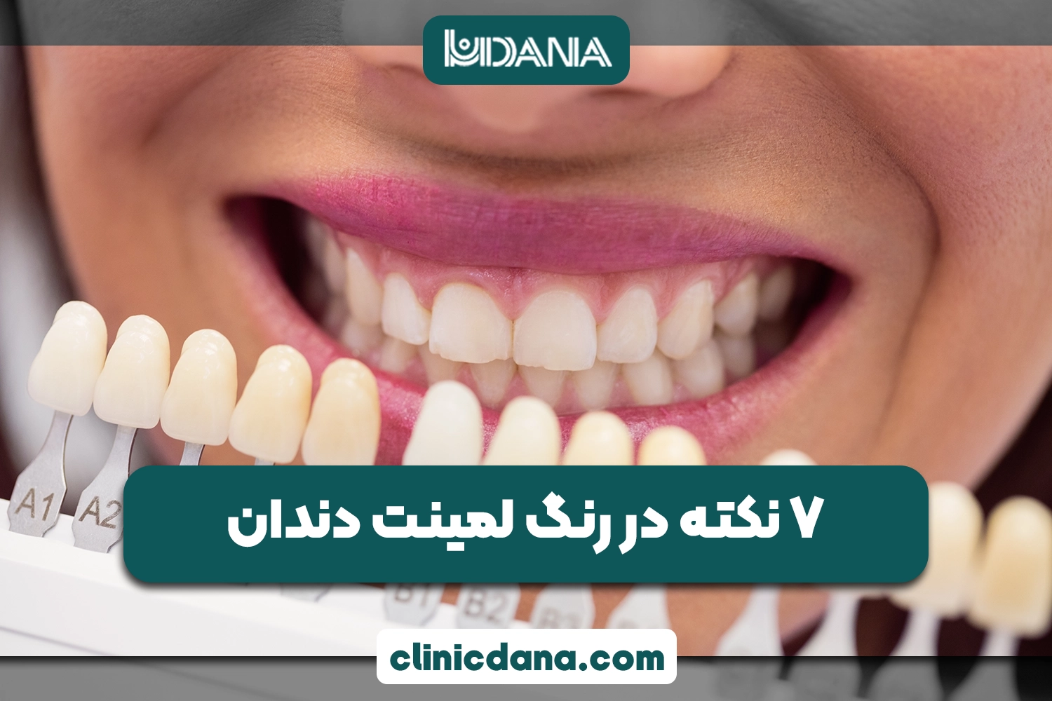 بررسی 7 نکته مهم انتخاب رنگ لمینت دندان