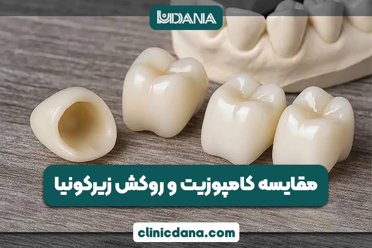 روکش زیرکونیا چیه؟ مقایسه کامپوزیت و روکش زیرکونیا