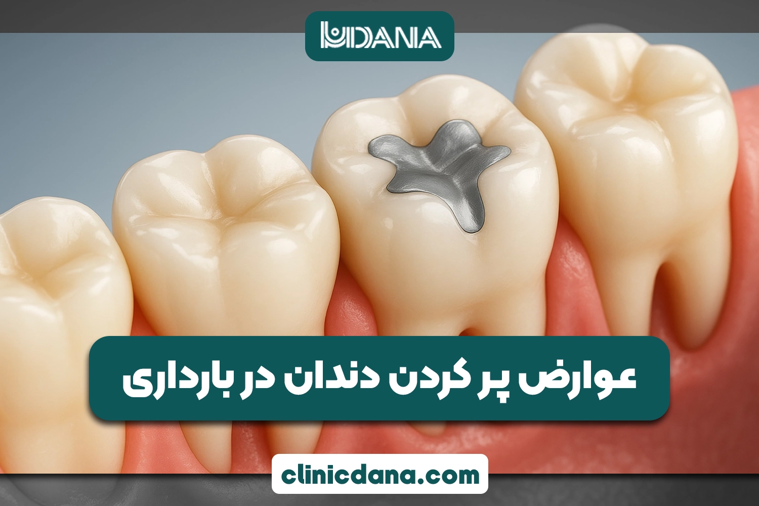 عوارض پر کردن دندان در بارداری؛ آیا در زمان حاملگی میتوان دندان پر کرد؟