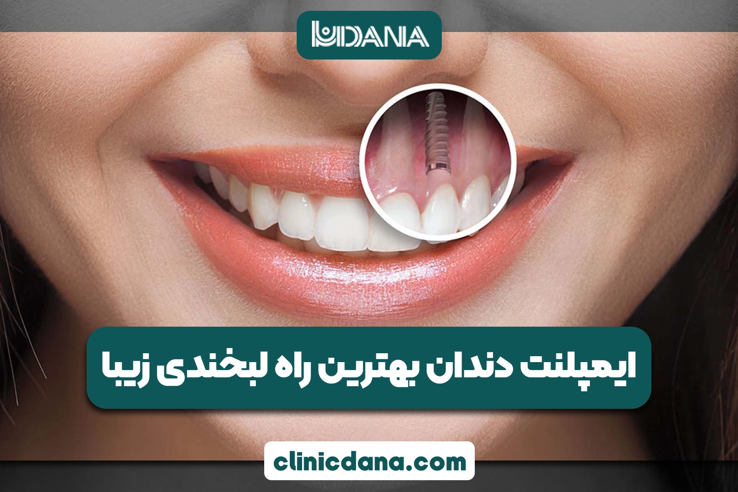 چرا ایمپلنت دندان بهترین راه برای داشتن لبخندی زیبا است؟
