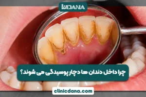 بزرگترین کلینیک چند تخصصی دندانپزشکی در شمال کشور 6 چرا داخل دندان ها دچار پوسیدگی می شوند؟؛ 7 راهکار برای جلوگیری از پوسیدگی داخل دندان ها