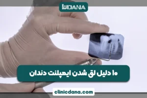 بزرگترین کلینیک چند تخصصی دندانپزشکی در شمال کشور 6 10 دلیل لق شدن ایمپلنت دندان؛ چرا ایمپلنت شل می شود و چطور از آن پیشگیری کنیم؟