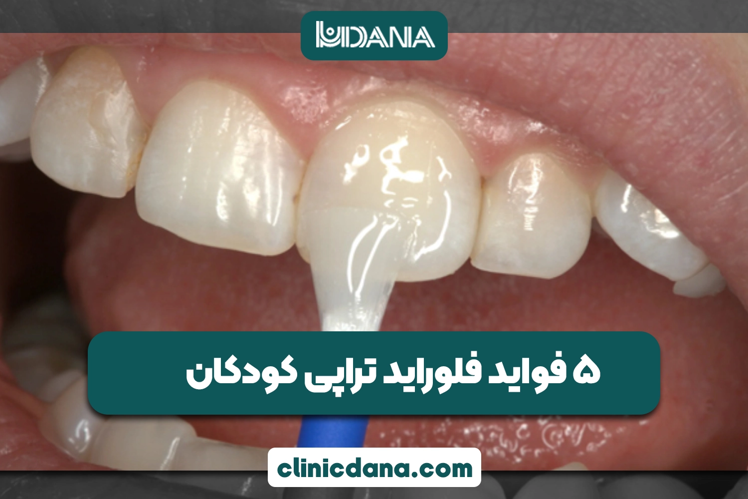 5 فواید فلوراید تراپی کودکان؛ کودکان میتوانند فلوراید تراپی انجام دهند؟