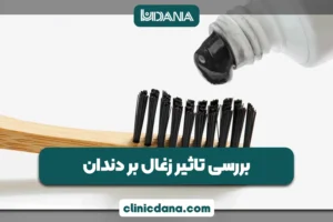 بزرگترین کلینیک چند تخصصی دندانپزشکی در شمال کشور 6 تاثیر زغال بر دندان؛ آیا خمیر دندان های دارای زغال برای دندان ها مفید هستند؟