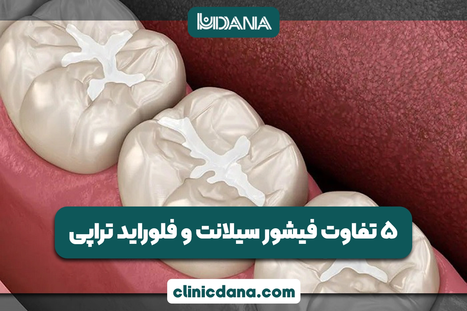 فیشور سیلانت چیست؟ 5 تفاوت‌ فیشور سیلانت و فلوراید تراپی
