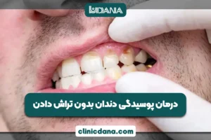 بزرگترین کلینیک چند تخصصی دندانپزشکی در شمال کشور 6 آیا پوسیدگی دندان بدون تراش درمان می شود؟ جدید ترین روش های 2026