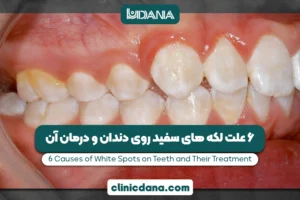 بزرگترین کلینیک چند تخصصی دندانپزشکی در شمال کشور 6 لکه های سفید روی دندان کودکان نشانه چیست؟ 6 علت لکه های سفید روی دندان و درمان آن