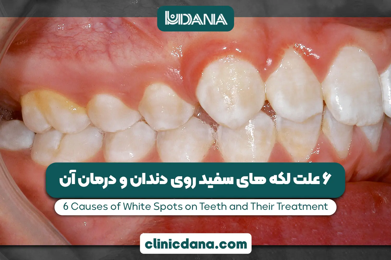 لکه های سفید روی دندان کودکان نشانه چیست؟ 6 علت لکه های سفید روی دندان و درمان آن