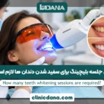چند جلسه بلیچینگ برای سفید شدن دندان ها لازم است؟