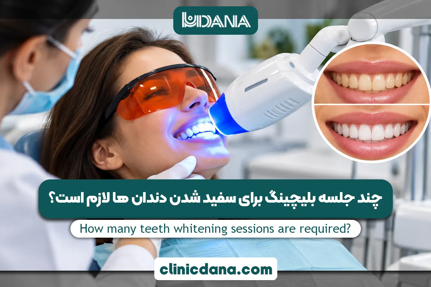 چند جلسه بلیچینگ برای سفید شدن دندان ها لازم است؟