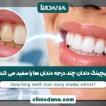 بلیچینگ دندان چند درجه دندان ها را سفید می کند؟
