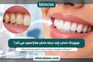 بزرگترین کلینیک چند تخصصی دندانپزشکی در شمال کشور 6 بلیچینگ دندان چند درجه دندان ها را سفید می کند؟