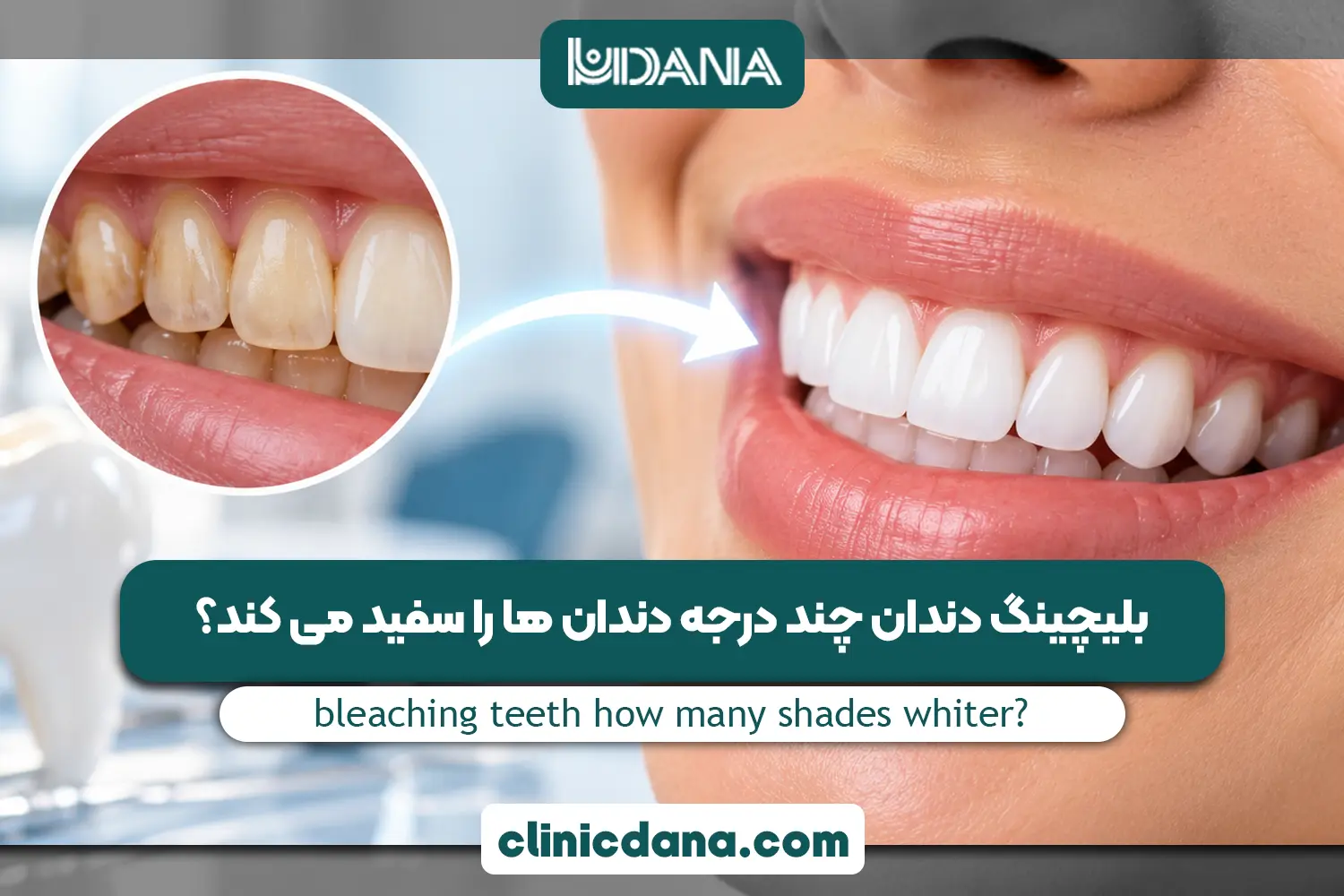 بلیچینگ دندان چند درجه دندان ها را سفید می کند؟